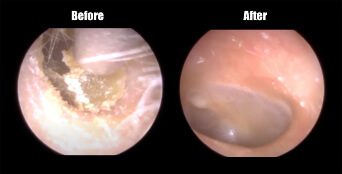 earwax removal before and after